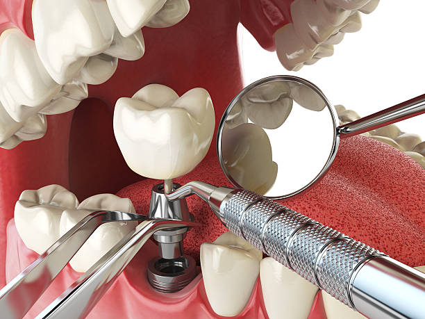 Best Emergency Treatment for Dental Infections or Abscesses in Atlanta, IL